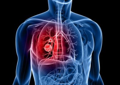 Cancer Prevalence and Treatment in India